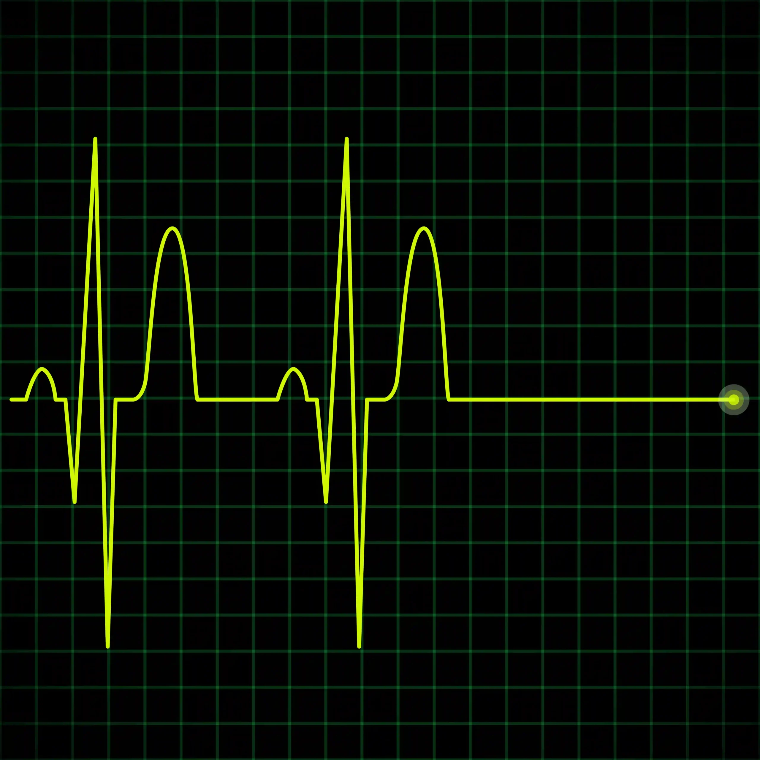 Yellow EKG waveform on a green grid, showing heart rhythm patterns, used for monitoring heart health at home