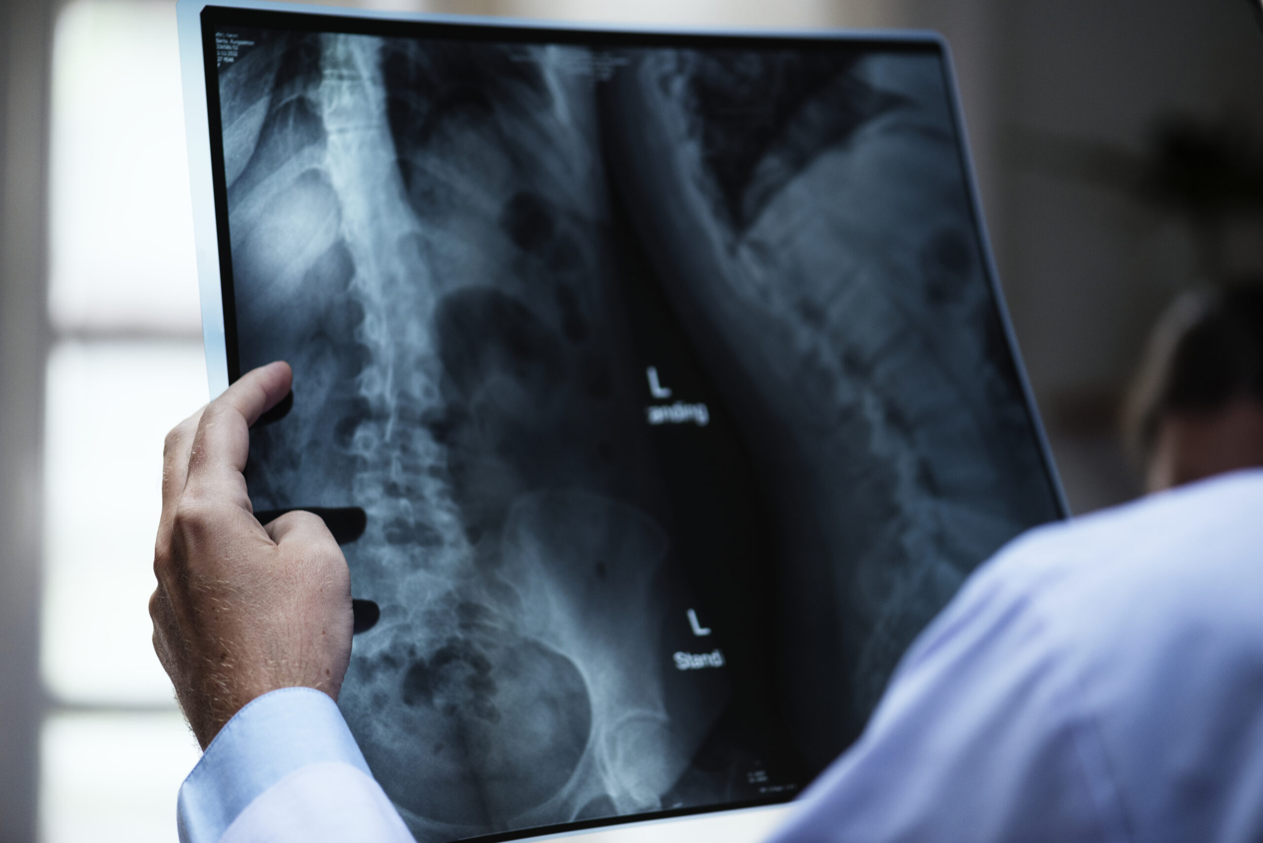 Physician holding and analyzing spinal X-ray in a well-lit clinical environment.